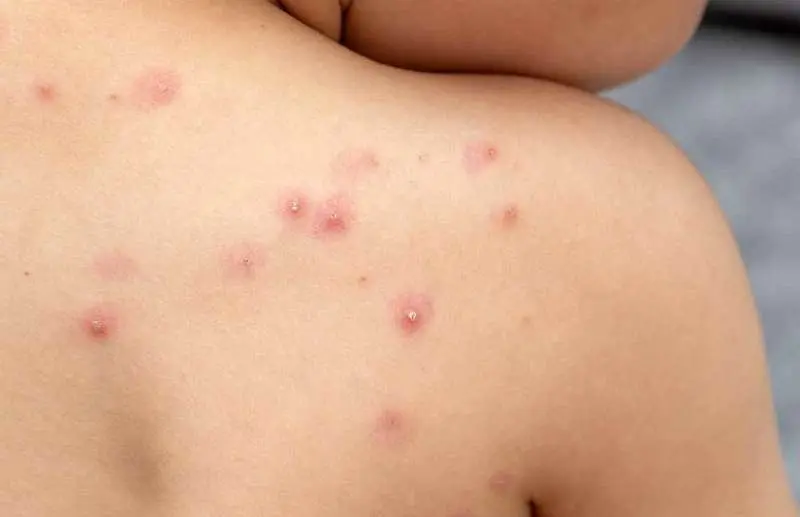 viruela-mono-asturias