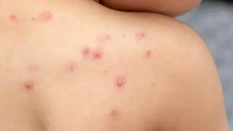 viruela-mono-asturias